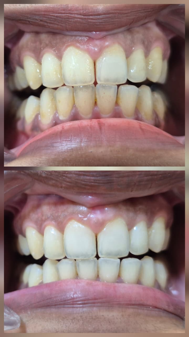 Before and after smile transformation 4
